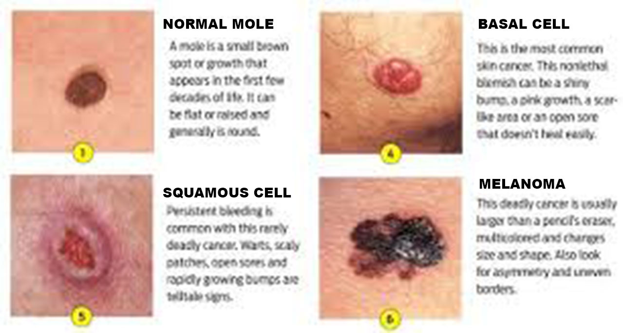 Skin Cancer Dermatology In Chevy Chase Md Chevy Chase Dermatology